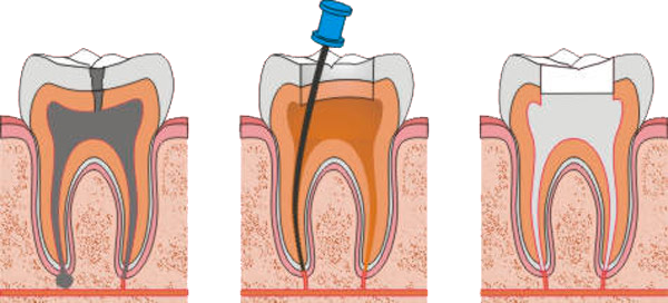 endodontzia