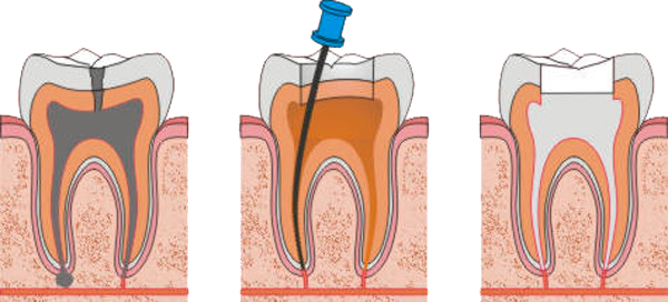 endodoncia